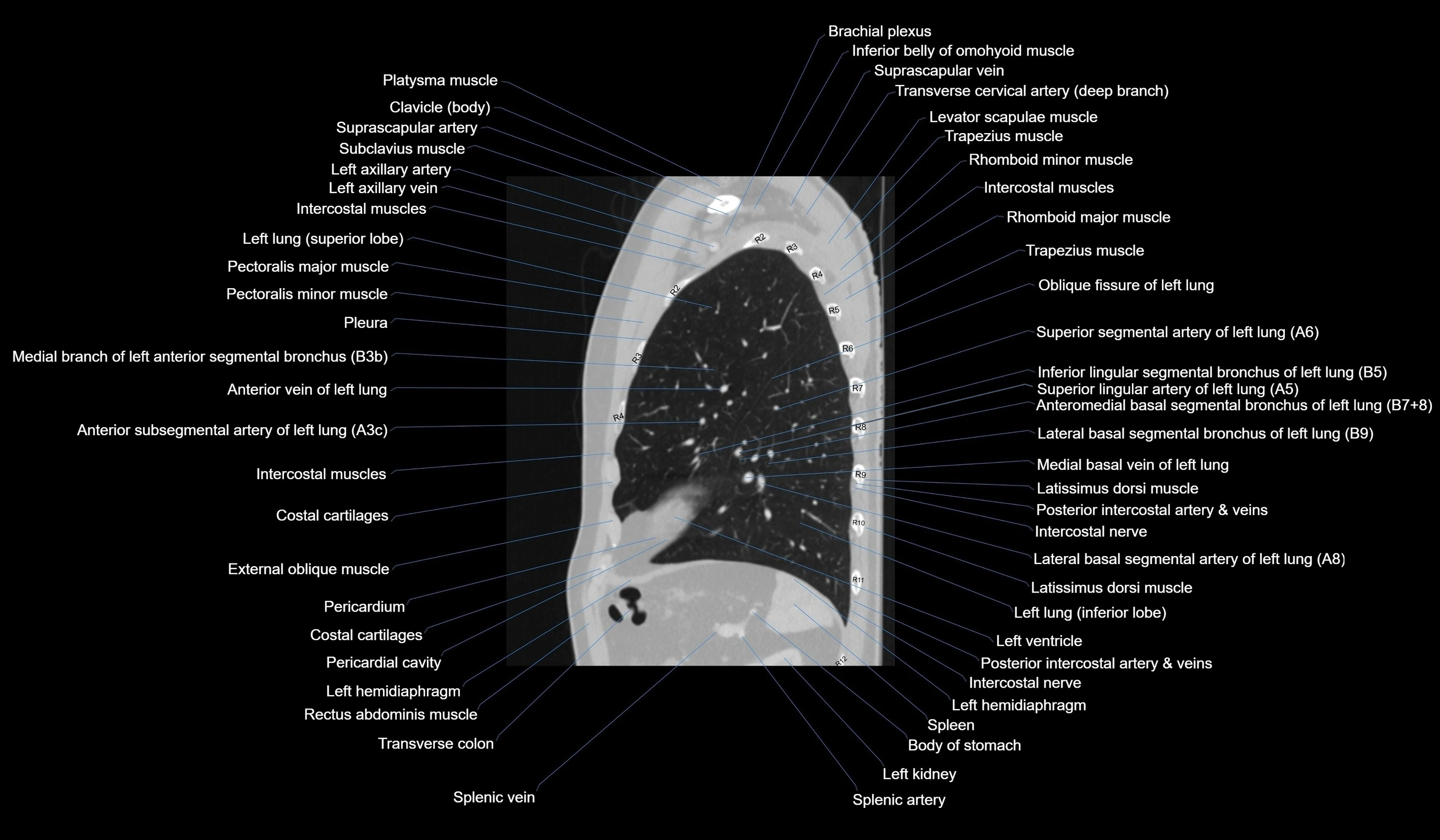 CT chest (thorax) labelled sagittal cross sectional anatomy radiology image-00106.webp
